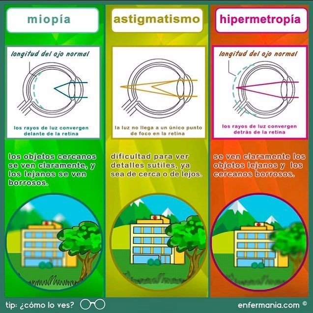 Diferencias entre miopía, hipermetropía y astigmatismo